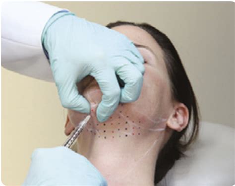 Weg met een onderkin: probeer Belkyra® (Kybella).